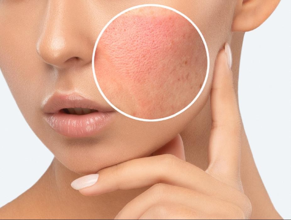 Cảm giác bỏng rát và đau sau khi sử dụng mỹ phẩm