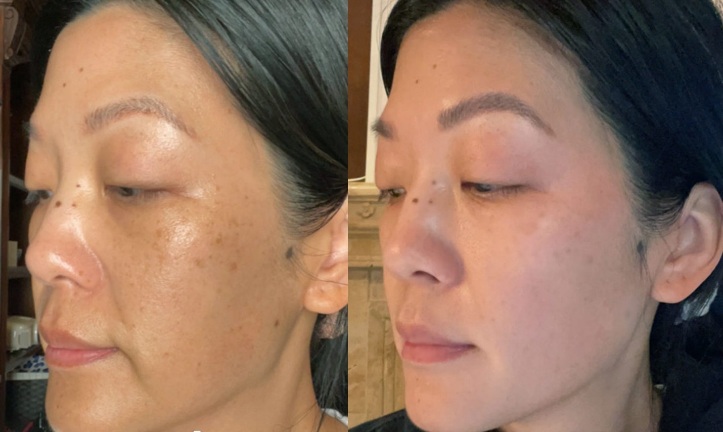 Hiệu quả của kem chống nắng Bihaku sau 3 tháng sử dụng