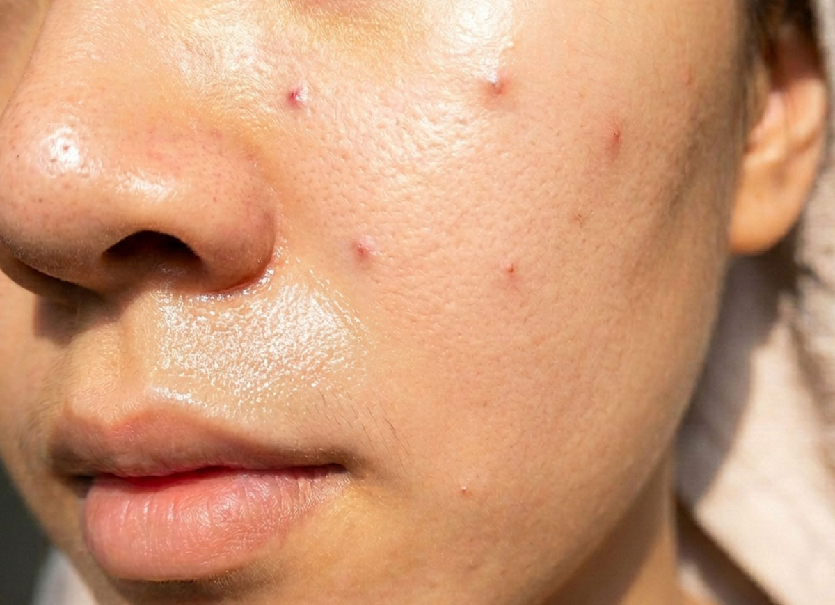 Làn da dầu mụn bị viêm nhiều