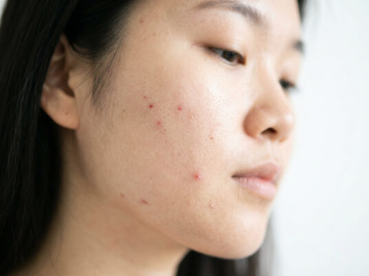 Tăng sắc tố sau viêm